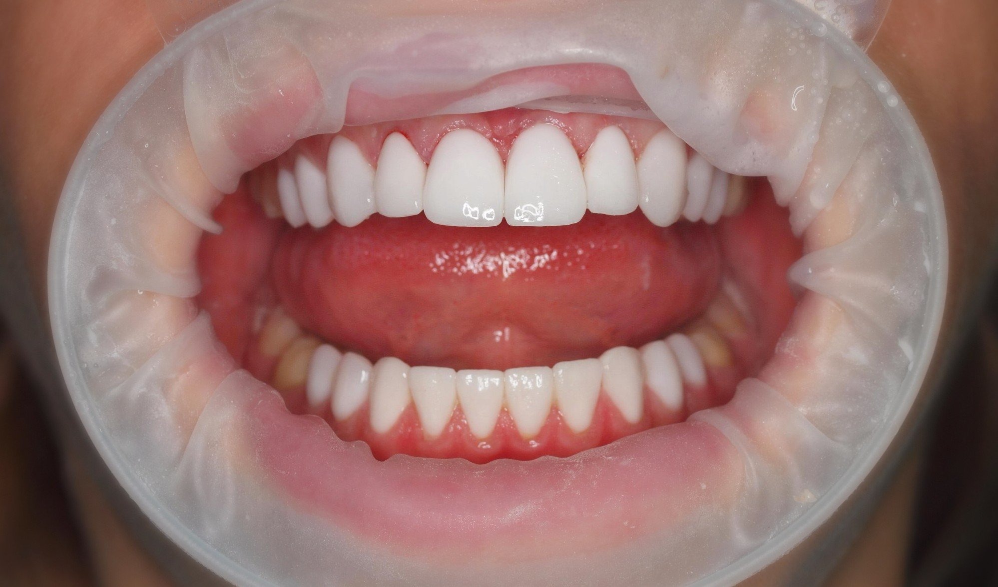 виниры цена на 1 зуб виниры цена на 1 зуб